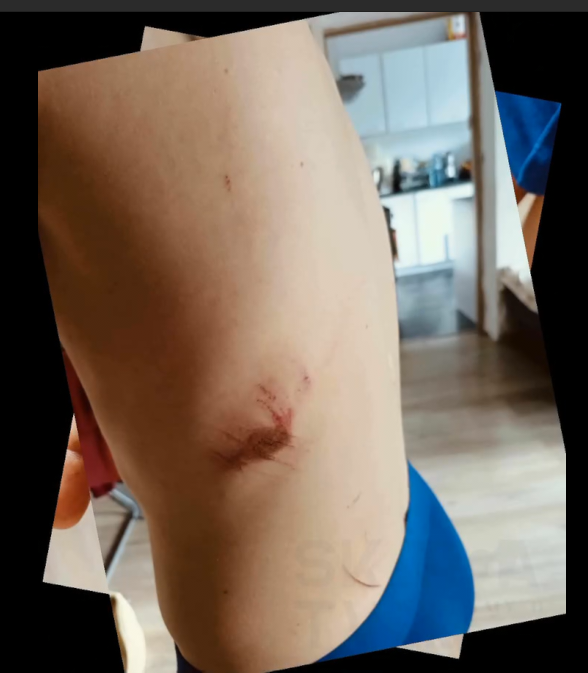 Brutalna czy uzasadniona interwencja Siemianowickiej policji 6 Brutalna czy uzasadniona interwencja Siemianowickiej policji — Zdjęcie poszkodowanego 04