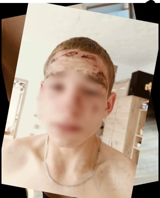 Brutalna czy uzasadniona interwencja Siemianowickiej policji 7 Brutalna czy uzasadniona interwencja Siemianowickiej policji — Zdjęcie poszkodowanego 05